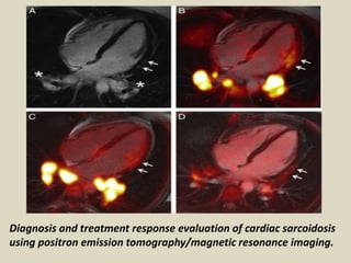 Diagnosis and treatment response evaluation of cardiac sarcoidosis
using positron emission tomography/magnetic resonance imaging.
 