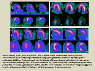 A to D, Imaging results from the 4 patients with probable cardiac sarcoidosis (ie, with high-degree
atrioventricular block and findings in cardiac imaging typical for cardiac sarcoidosis despite negative
endomyocardial biopsy findings. In each part, the top row of images shows a technetium-99m-tetrofosmin
myocardial perfusion image, and the bottom row shows the corresponding 18F-2-deoxyglucose uptake. Every
patient had a localized septal perfusion defect (*) with a super imposable hot spot on PET imaging suggestive
of active inflammation. FDG F-18 indicates 18F-2-deoxyglucose; Tc, technetium-99m.
 