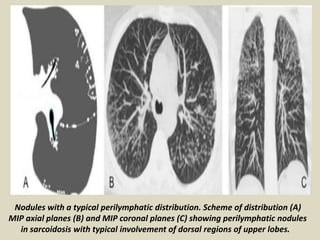 Nodules with a typical perilymphatic distribution. Scheme of distribution (A)
MIP axial planes (B) and MIP coronal planes (C) showing perilymphatic nodules
in sarcoidosis with typical involvement of dorsal regions of upper lobes.
 