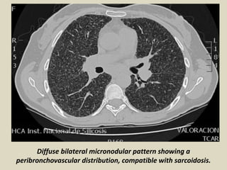Diffuse bilateral micronodular pattern showing a
peribronchovascular distribution, compatible with sarcoidosis.
 