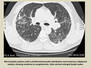 Micronodular pattern with a peribronchovascular distribution and numerous subpleural
nodules showing tendency to conglomerate. Infra-carinal enlarged lymph nodes.
 