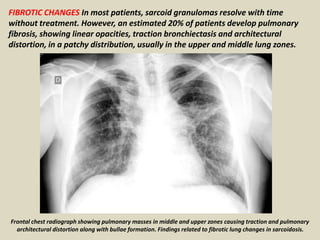FIBROTIC CHANGES In most patients, sarcoid granulomas resolve with time
without treatment. However, an estimated 20% of patients develop pulmonary
fibrosis, showing linear opacities, traction bronchiectasis and architectural
distortion, in a patchy distribution, usually in the upper and middle lung zones.
Frontal chest radiograph showing pulmonary masses in middle and upper zones causing traction and pulmonary
architectural distortion along with bullae formation. Findings related to fibrotic lung changes in sarcoidosis.
 