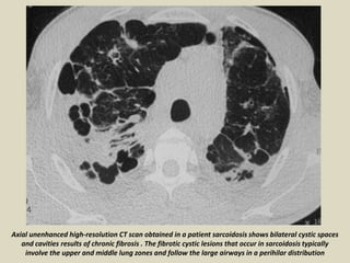 Axial unenhanced high-resolution CT scan obtained in a patient sarcoidosis shows bilateral cystic spaces
and cavities results of chronic fibrosis . The fibrotic cystic lesions that occur in sarcoidosis typically
involve the upper and middle lung zones and follow the large airways in a perihilar distribution
 