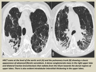 HRCT scans at the level of the aortic arch (A) and the pulmonary trunk (B) showing a classic
appearance of advanced fibrotic sarcoidosis. A dense conglomerate mass in the right upper lobe
and bilateral traction bronchiectasis that radiate from the hilum towards the dorsal regions of
upper lobes. There is also evident intralobular interstitial thickening in the upper lobes.
 