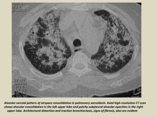 Alveolar sarcoid pattern of airspace consolidation in pulmonary sarcoidosis. Axial high-resolution CT scan
shows alveolar consolidation in the left upper lobe and patchy subpleural alveolar opacities in the right
upper lobe. Architectural distortion and traction bronchiectasis, signs of fibrosis, also are evident
 
