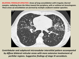 BILATERAL PERIHILAR OPACITIES: Areas of lung consolidation with irregular, blurred
margins, radiating from the hilum toward the periphery, with or without air bronchogram.
These areas of consolidation are formed by multiple confluent nodular opacities.
Centrilobular and subpleural micronodular interstitial pattern accompanied
by diffuse bilateral reticular areas with more extensive involvement of
perihilar regions. Suggestive findings of stage III sarcoidosis.
 