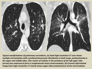 Typical manifestations of pulmonary sarcoidosis. (a) Axial high-resolution CT scan shows
multiple micronodules with a peribronchovascular distribution in both lungs, predominantly in
the upper and middle lobes. One cluster of nodules in the periphery of the left upper lobe
(arrow) has coalesced to form a conglomerate lesion (macronodule). (b) Coronal reformatted
image from high-resolution CT clearly shows upper-lobe predominance of the micronodules.
 