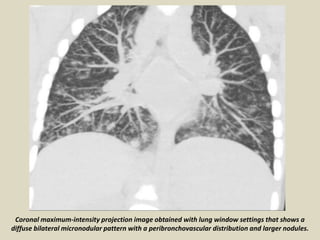 Coronal maximum-intensity projection image obtained with lung window settings that shows a
diffuse bilateral micronodular pattern with a peribronchovascular distribution and larger nodules.
 