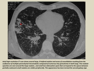 Axial high-resolution CT scan shows several large, ill-defend nodules and areas of consolidation resulting from the
confluence of multiple parenchymal micronodules composed of numerous tiny granulomas in both lungs. Fine nodular
opacities are seen around the large nodules , and small low-attenuation spots that correspond to the spaces between
partially coalescent small nodules are visible peripherally. This appearance has been termed the sarcoid galaxy sign.
 