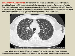 LINEAR RETICULAR OPACITIES This pattern is produced by interlobular and intralobular
septal thickening and is commonly seen in the subpleural space of the upper and middle
lung zones. Although this pattern may simulate lymphangitic carcinomatosis, this disorder
is characterized by a more extensive and more severe involvement of the interlobular septa
and subpleural space than is typical either in lymphoma or in sarcoidosis.
HRCT. Mixed pattern with a diffuse thickening of the interstitium, with both linear and
nodular characteristics, along with thickening of the peripheral septa and axial interstitium.
 