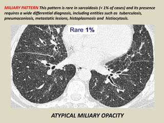 MILIARY PATTERN This pattern is rare in sarcoidosis (< 1% of cases) and its presence
requires a wide differential diagnosis, including entities such as tuberculosis,
pneumoconiosis, metastatic lesions, histoplasmosis and histiocytosis.
ATYPICAL MILIARY OPACITY
 