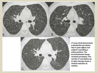 CT scans (A,B) demonstrate
a distribution of nodules
that is quite diffuse and
uniform resembling a
miliary pattern. The
bronchoalveolar lavage
revealed sarcoidosis. Five
months CT scan follow-up
(c) after therapy shows a
marked reduction of
nodules.
 