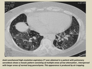 Axial unenhanced high-resolution expiratory CT scan obtained in a patient with pulmonary
sarcoidosis shows a mosaic pattern consisting of multiple areas of low attenuation , interspersed
with larger areas of normal lung parenchyma. This appearance is produced by air trapping.
 