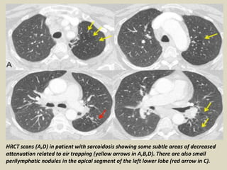HRCT scans (A,D) in patient with sarcoidosis showing some subtle areas of decreased
attenuation related to air trapping (yellow arrows in A,B,D). There are also small
perilymphatic nodules in the apical segment of the left lower lobe (red arrow in C).
 