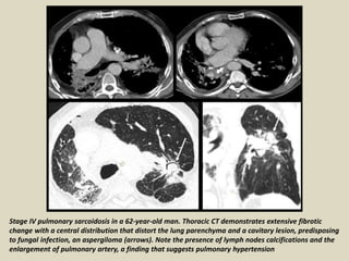 Stage IV pulmonary sarcoidosis in a 62-year-old man. Thoracic CT demonstrates extensive fibrotic
change with a central distribution that distort the lung parenchyma and a cavitary lesion, predisposing
to fungal infection, an aspergiloma (arrows). Note the presence of lymph nodes calcifications and the
enlargement of pulmonary artery, a finding that suggests pulmonary hypertension
 