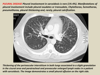 PLEURAL DISEASE Pleural involvement in sarcoidosis is rare (1%-4%). Manifestations of
pleural involvement include pleural exudates or transudate, Chylothorax, hemothorax,
pneumothorax, pleural thickening and, rarely, pleural calcification.
Thickening of the perivascular interstitium in both lungs associated to a slight granulation
in the cisural area and paratracheal and prevascular enlarged lymph nodes in a patient
with sarcoidosis. The image demonstrates a small pleural effusion on the right side.
 