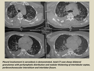 Pleural involvement in sarcoidosis is demonstrated. Axial CT scan shows bilateral
granulomas with perilymphatic distribution and nodular thickening of interlobular septae,
peribronchovascular interstitium and interlobar fissure.
 