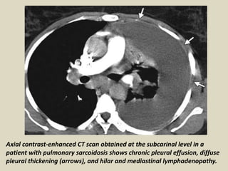 Axial contrast-enhanced CT scan obtained at the subcarinal level in a
patient with pulmonary sarcoidosis shows chronic pleural effusion, diffuse
pleural thickening (arrows), and hilar and mediastinal lymphadenopathy.
 
