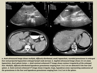 a. Axial ultrasound image shows multiple, diffusely distributed, small, hypoechoic, rounded granulomas in enlarged
liver and periportal hypoechoic enlarged lymph node (arrow). b. Sagittal ultrasound image shows 3.5 cm sized,
hypoechoic, focal splenic lesion. c. Axial contrast enhanced CT image shows contour irregularity of the enlarged
liver. Multiple, diffusely distributed hypodense granulomas ranging from 1 to 2 cm are detected in the liver and
spleen. d. Axial contrast enhanced CT image shows irregular, large, hypodense areas representing coalescence of
the granulomas in the liver and hypodense granulomas ranging from 1 to 2 cm in the spleen.
 