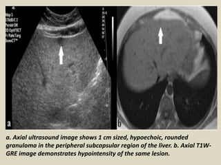a. Axial ultrasound image shows 1 cm sized, hypoechoic, rounded
granuloma in the peripheral subcapsular region of the liver. b. Axial T1W-
GRE image demonstrates hypointensity of the same lesion.
 
