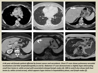 A 66-year-old female patient affected by breast cancer and sarcoidosis. Chest CT-scan shows pulmonary sarcoidal
localizations and hilar lymphadenopathy (a and b). Abdomen CT scan demonstrates a slightly hypo-attenuating
small liver lesion (c; white arrow) with associated enlarged lymph-nodes (d). MRI (e and f) also shows both liver
lesion (e; white curved arrow), which appears hypo-intense in hepatobiliary phase, and lymph-nodes (f).
 