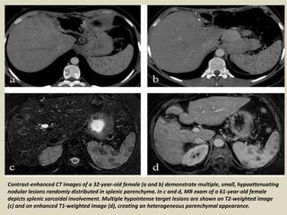 Contrast-enhanced CT images of a 32-year-old female (a and b) demonstrate multiple, small, hypoattenuating
nodular lesions randomly distributed in splenic parenchyma. In c and d, MR exam of a 61-year-old female
depicts splenic sarcoidal involvement. Multiple hypointense target lesions are shown on T2-weighted image
(c) and on enhanced T1-weighted image (d), creating an heterogeneous parenchymal appearance.
 