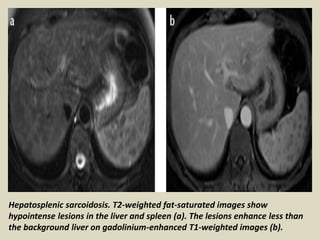 Hepatosplenic sarcoidosis. T2-weighted fat-saturated images show
hypointense lesions in the liver and spleen (a). The lesions enhance less than
the background liver on gadolinium-enhanced T1-weighted images (b).
 