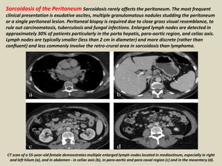 Sarcoidosis of the Peritoneum Sarcoidosis rarely affects the peritoneum. The most frequent
clinical presentation is exudative ascites, multiple granulomatous nodules studding the peritoneum
or a single peritoneal lesion. Peritoneal biopsy is required due to close gross visual resemblance, to
rule out carcinomatosis, tuberculosis and fungal infections. Enlarged lymph nodes are detected in
approximately 30% of patients particularly in the porta hepatis, para-aortic region, and celiac axis.
Lymph nodes are typically smaller (less than 2 cm in diameter) and more discrete (rather than
confluent) and less commonly involve the retro-crural area in sarcoidosis than lymphoma.
CT scan of a 55-year-old female demonstrates multiple enlarged lymph-nodes located in mediastinum, especially in right
and left hilum (a), and in abdomen - in celiac axis (b), in para-aortic and para caval region (c) and in the mesentery (d).
 