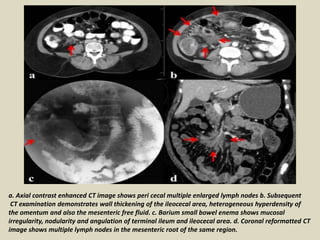 a. Axial contrast enhanced CT image shows peri cecal multiple enlarged lymph nodes b. Subsequent
CT examination demonstrates wall thickening of the ileocecal area, heterogeneous hyperdensity of
the omentum and also the mesenteric free fluid. c. Barium small bowel enema shows mucosal
irregularity, nodularity and angulation of terminal ileum and ileocecal area. d. Coronal reformatted CT
image shows multiple lymph nodes in the mesenteric root of the same region.
 
