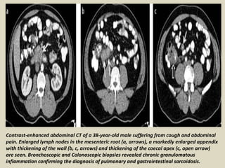 Contrast-enhanced abdominal CT of a 38-year-old male suffering from cough and abdominal
pain. Enlarged lymph nodes in the mesenteric root (a, arrows), a markedly enlarged appendix
with thickening of the wall (b, c, arrows) and thickening of the coecal apex (c, open arrow)
are seen. Bronchoscopic and Colonoscopic biopsies revealed chronic granulomatous
inflammation confirming the diagnosis of pulmonary and gastrointestinal sarcoidosis.
 