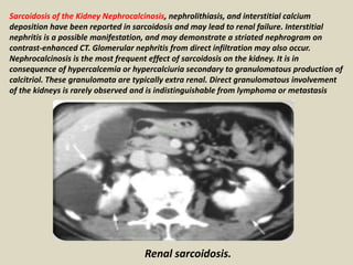Sarcoidosis of the Kidney Nephrocalcinosis, nephrolithiasis, and interstitial calcium
deposition have been reported in sarcoidosis and may lead to renal failure. Interstitial
nephritis is a possible manifestation, and may demonstrate a striated nephrogram on
contrast-enhanced CT. Glomerular nephritis from direct infiltration may also occur.
Nephrocalcinosis is the most frequent effect of sarcoidosis on the kidney. It is in
consequence of hypercalcemia or hypercalciuria secondary to granulomatous production of
calcitriol. These granulomata are typically extra renal. Direct granulomatous involvement
of the kidneys is rarely observed and is indistinguishable from lymphoma or metastasis
Renal sarcoidosis.
 