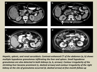 Hepatic, splenic, and renal sarcoidosis. Contrast-enhanced CT of the abdomen (a, b) shows
multiple hypodense granulomas infiltrating the liver and spleen. Small hypodense
granulomas are also detected in both kidneys (a, b, arrows). Contour irregularity of the
shrinking liver became prominent (c, dashed arrows) and contour irregularity of the right
kidney at the site of granuloma occurred (d, dashed arrow) at five-month follow-up
 