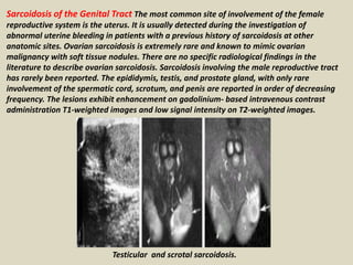 Sarcoidosis of the Genital Tract The most common site of involvement of the female
reproductive system is the uterus. It is usually detected during the investigation of
abnormal uterine bleeding in patients with a previous history of sarcoidosis at other
anatomic sites. Ovarian sarcoidosis is extremely rare and known to mimic ovarian
malignancy with soft tissue nodules. There are no specific radiological findings in the
literature to describe ovarian sarcoidosis. Sarcoidosis involving the male reproductive tract
has rarely been reported. The epididymis, testis, and prostate gland, with only rare
involvement of the spermatic cord, scrotum, and penis are reported in order of decreasing
frequency. The lesions exhibit enhancement on gadolinium- based intravenous contrast
administration T1-weighted images and low signal intensity on T2-weighted images.
Testicular and scrotal sarcoidosis.
 