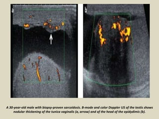 A 30-year-old male with biopsy-proven sarcoidosis. B-mode and color Doppler US of the testis shows
nodular thickening of the tunica vaginalis (a, arrow) and of the head of the epidydimis (b).
 
