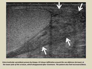 Extra-testicular sarcoidosis proven by biopsy. US shows infiltration around the vas deferens (arrows), at
the lower pole of the scrotum, which disappeared after treatment. The patient also had neurosarcoidosis.
 