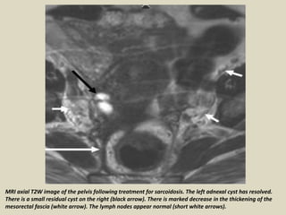 MRI axial T2W image of the pelvis following treatment for sarcoidosis. The left adnexal cyst has resolved.
There is a small residual cyst on the right (black arrow). There is marked decrease in the thickening of the
mesorectal fascia (white arrow). The lymph nodes appear normal (short white arrows).
 