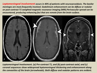 Leptomeningeal involvement occurs in 40% of patients with neurosarcoidosis. The basilar
meninges are most frequently involved. Gadolinium enhancement can be diffuse or nodular
on post-contrast T1-weighted magnetic resonance imaging (MRI).Perivascular spread can be
encountered, producing enhancing foci that are remote from the brain surface.
Leptomeningeal Involvement. (a) Pre-contrast T1, and (b) post-contrast axial, and (c)
coronal sequences show widespread leptomeningeal thickening and enhancement along
the convexities of the brain (arrowheads). Both diffuse and nodular patterns are evident.
 