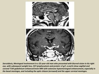 Sarcoidosis, Meningeal involvement in a 32-year-old man who presented with blurred vision in his right
eye, with subsequent weight loss, CSF lymphocytosis and protein >2 g/l. a and b show sagittal and
coronal T1W gadolinium-enhanced brain MRI with extensive leptomeningeal enhancement, especially in
the basal meninges, and including the optic chiasm (arrowed) and the upper cervical meninges.
 