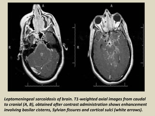 Leptomeningeal sarcoidosis of brain. T1-weighted axial images from caudal
to cranial (A, B), obtained after contrast administration shows enhancement
involving basilar cisterns, Sylvian fissures and cortical sulci (white arrows).
 