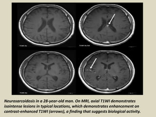 Neurosarcoidosis in a 28-year-old man. On MRI, axial T1WI demonstrates
isointense lesions in typical locations, which demonstrates enhancement on
contrast-enhanced T1WI (arrows), a finding that suggests biological activity.
 