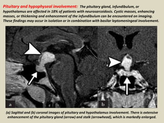 Pituitary and hypophyseal involvement: The pituitary gland, infundibulum, or
hypothalamus are affected in 18% of patients with neurosarcoidosis. Cystic masses, enhancing
masses, or thickening and enhancement of the infundibulum can be encountered on imaging.
These findings may occur in isolation or in combination with basilar leptomeningeal involvement.
(a) Sagittal and (b) coronal images of pituitary and hypothalamus Involvement. There is extensive
enhancement of the pituitary gland (arrow) and stalk (arrowhead), which is markedly enlarged.
 