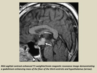 Mid sagittal contrast-enhanced T1-weighted brain magnetic resonance image demonstrating
a gadolinium-enhancing mass of the floor of the third ventricle and hypothalamus (arrow).
 