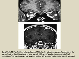 Sarcoidosis, T1W gadolinium-enhanced coronal MRI showing a thickening and enhancement of the
dural sheath of the right optic nerve (a, arrowed). Widespread dural enhancement with focal
thickening of the meninges over the convexity and the left temporal region is also seen (b, arrowed).
 