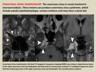 Cavernous sinus involvement: The cavernous sinus is rarely involved in
neurosarcoidosis. These lesions can produce cavernous sinus syndrome, which
include painful ophthalmoplegia. Lesions enhance and may have a dural tail.
Cavernous Sinus Involvement. (a) Axial T2 magnetic resonance imaging (MRI) scan shows a hypointense lesion
in the right cavernous sinus (arrowheads). (b) Axial and (c) coronal post-contrast T1-weighted sequences show
that the enhancing mass in the right cavernous sinus (arrowheads). The carotid artery is patent.
 