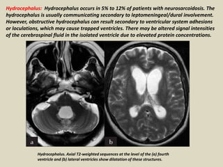 Hydrocephalus: Hydrocephalus occurs in 5% to 12% of patients with neurosarcoidosis. The
hydrocephalus is usually communicating secondary to leptomeningeal/dural involvement.
However, obstructive hydrocephalus can result secondary to ventricular system adhesions
or loculations, which may cause trapped ventricles. There may be altered signal intensities
of the cerebrospinal fluid in the isolated ventricle due to elevated protein concentrations.
Hydrocephalus. Axial T2-weighted sequences at the level of the (a) fourth
ventricle and (b) lateral ventricles show dilatation of these structures.
 