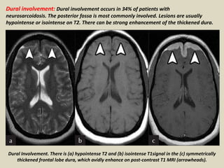 Dural involvement: Dural involvement occurs in 34% of patients with
neurosarcoidosis. The posterior fossa is most commonly involved. Lesions are usually
hypointense or isointense on T2. There can be strong enhancement of the thickened dura.
Dural Involvement. There is (a) hypointense T2 and (b) isointense T1signal in the (c) symmetrically
thickened frontal lobe dura, which avidly enhance on post-contrast T1 MRI (arrowheads).
 