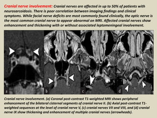 Cranial nerve involvement: Cranial nerves are affected in up to 50% of patients with
neurosarcoidosis. There is poor correlation between imaging findings and clinical
symptoms. While facial nerve deficits are most commonly found clinically, the optic nerve is
the most common cranial nerve to appear abnormal on MRI. Affected cranial nerves show
enhancement and thickening with or without associated leptomeningeal involvement.
Cranial nerve involvement. (a) Coronal post-contrast T1-weighted MRI shows peripheral
enhancement of the bilateral cisternal segments of cranial nerve II. (b) Axial post-contrast T1-
weighted sequences at the level of cranial nerve V, (c) cranial nerves VII and VIII, and (d) cranial
nerve IX show thickening and enhancement of multiple cranial nerves (arrowheads).
 