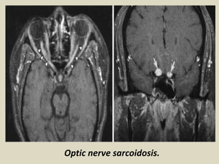 Optic nerve sarcoidosis.
 