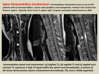 Spine intramedullary involvement: Intramedullary involvement occurs in up to 25%
patients with of neurosarcoidosis. Lesions cause fusiform cord enlargement, mainly in the cervical and
thoracic regions. Typically, there is low T1 signal, high T2 signal, and patchy enhancement on MRI.
Intramedullary spinal cord involvement. (a) Sagittal T2, (b) sagittal T1 and (c) sagittal post-
contrast T1 sequences is high T2 signal within the spinal cord (arrowheads). A portion of
the lesion demonstrates intense enhancement (arrowhead). The cord is mildly expanded.
 