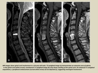 MR images show spinal cord involvement in a 54-year-old male. T2-weighted image (a) demonstrates an extensive area of edema
in the spinal cord (white arrow); unenhanced T1-weighted image (b) only shows swelling of the spinal cord. On enhanced T1-weighted
acquisitions, a peripheral enhancement (curved white arrow) can be depicted (c), suggesting meningeal involvement.
 